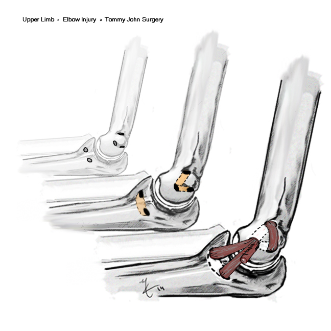 Tommy John Surgery